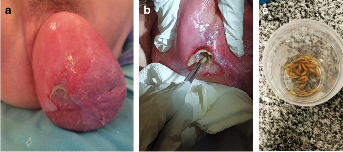 A case of myiasis in stage IV pelvic organ prolapse