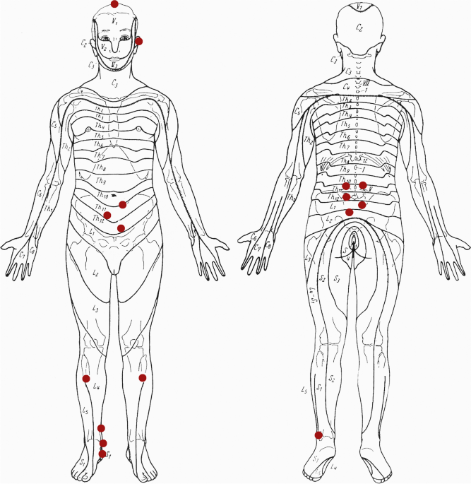 Segmental Acupuncture for Prevention of Recurrent Urinary Tract Infections. A Randomised Clinical Trial