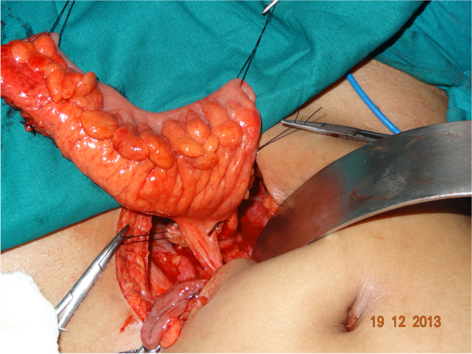 Long-Term Outcomes of the Restoration of Uterovaginal Continuity and Vaginoplasty—Utero-Colo-Neovaginoplasty—in Cervicovaginal Agenesis Using the Sigmoid Colon