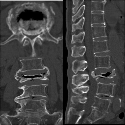 Cheltenham Spine Clinic - Osteoporotic Vertebral Compression Fractures