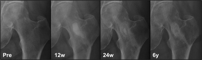 Bilateral hip DXA scan image from a 59-year-old post-menopausal woman.