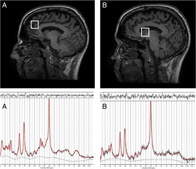n-acetylcysteine as a glutathione precursor for schizophrenia Effects of N-acetylcysteine on brain glutamate levels and resting perfusion  in schizophrenia | Psychopharmacology