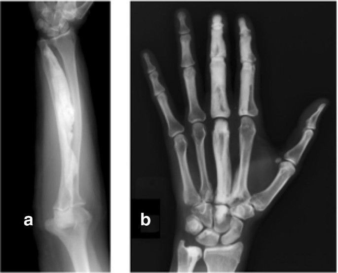 Dripping candle wax, Radiology Case