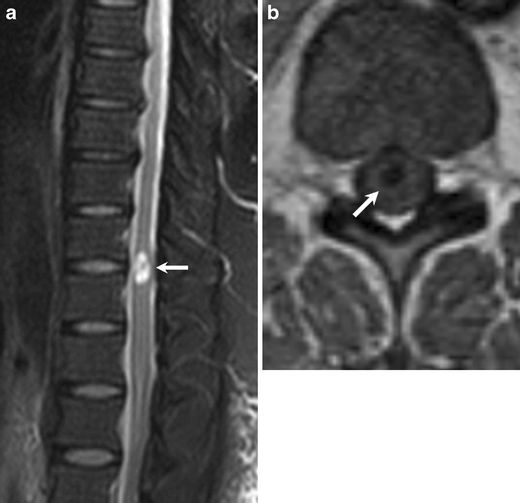 Isolated spinal neurenteric cyst presenting as intramedullary calcified  cystic mass on imaging studies: case report and review of literature |  Neuroradiology