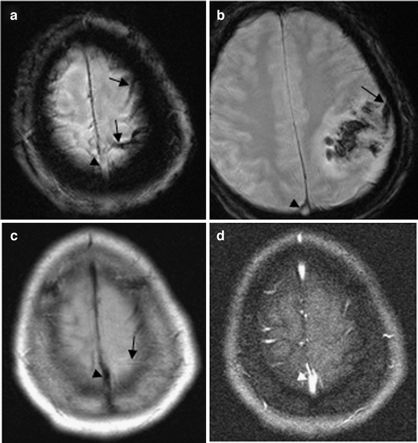 cortical vein thrombosis