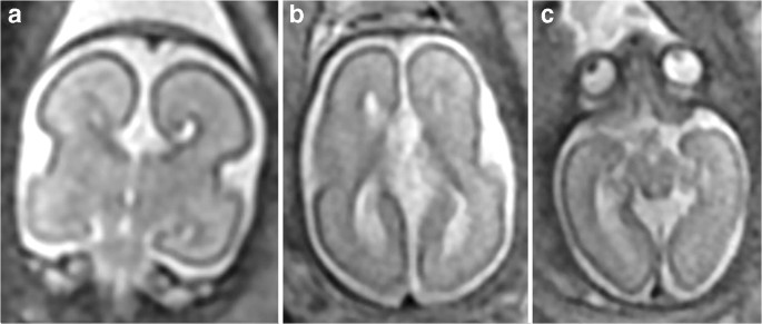 Use of MRI in the diagnosis of fetal brain abnormalities in utero  (MERIDIAN): a multicentre, prospective cohort study - The Lancet