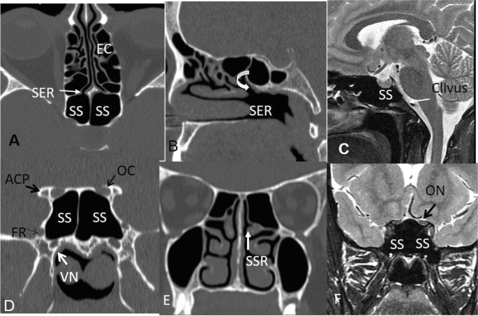 Pathologies du sinus frontal