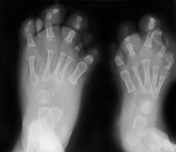 Surgical treatment of macrodactyly in Proteus syndrome | European Journal  of Plastic Surgery