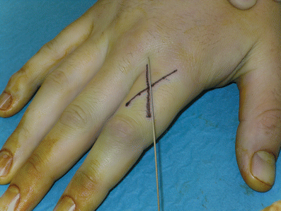 A simple method to optimise Kirschner wire fixation of hand fractures |  European Journal of Plastic Surgery