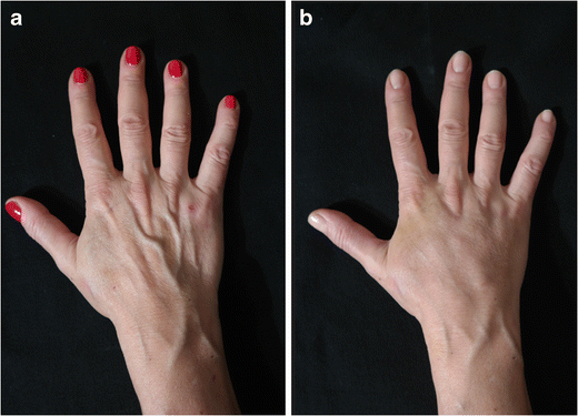 Hand rejuvenation with fat grafting: A 12-year single-surgeon experience |  European Journal of Plastic Surgery