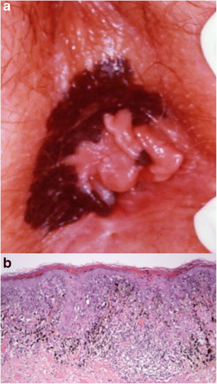 The treatment of perianal skin horseshoe melanoma by advancement flap (Y-V  shaped) and the assessment of outcome over a long-term follow-up | European  Journal of Plastic Surgery