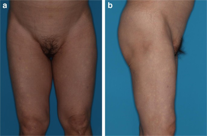 Multiple symmetric lipomatosis with vulvar involvement: a rare case report  associated with walking difficulty and urination disorder