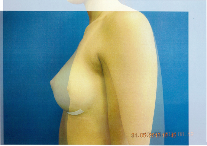 Breast Augmentation – Patient 321