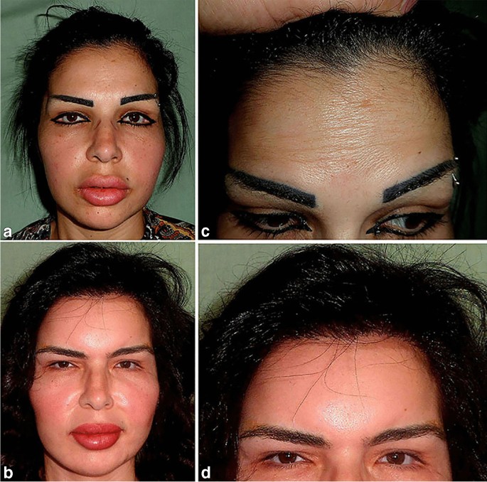 Elmelegy's modified technique for durable forehead rejuvenation using a  novel instrument and fat transfer | European Journal of Plastic Surgery