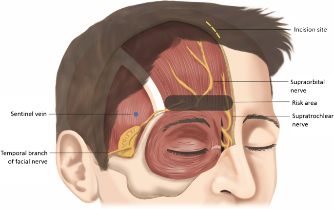 Table 1 from Alternative Treatment of Osteoma Using an Endoscopic  Holmium-YAG Laser