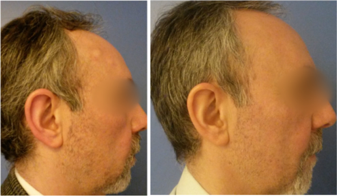 Table 1 from Alternative Treatment of Osteoma Using an Endoscopic  Holmium-YAG Laser