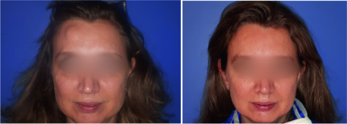 Table 1 from Alternative Treatment of Osteoma Using an Endoscopic  Holmium-YAG Laser