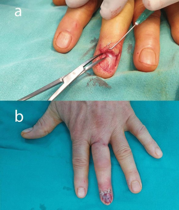 Glomus tumor of the fingertips: A frequently missed diagnosis. - Abstract -  Europe PMC