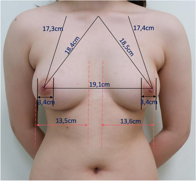 Breast anthropometry in Vietnamese youth: a comprehensive study of