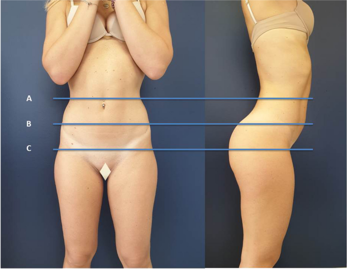 The ideal buttock: some aesthetic and morphometric considerations