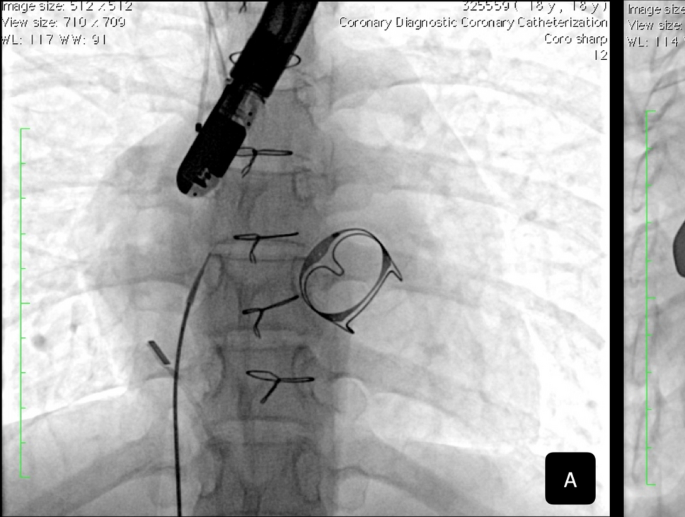 University of California, San Francisco: Lung Shaped Blood Clot Formed In  Exact Shape Of A Lung Passage. Man Coughed It Out