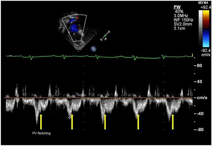 Mid-Systolic Notching of the Pulmonary Valve Doppler Signal is Highly  Associated with Pulmonary Hypertension | Pediatric Cardiology