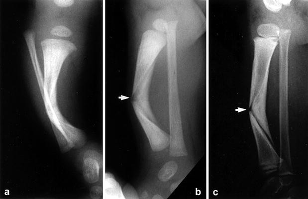 An unusual form of congenital anterolateral tibial angulation—the delta  tibia