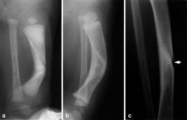 An unusual form of congenital anterolateral tibial angulation—the delta  tibia