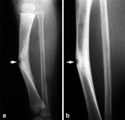 An unusual form of congenital anterolateral tibial angulation—the delta  tibia