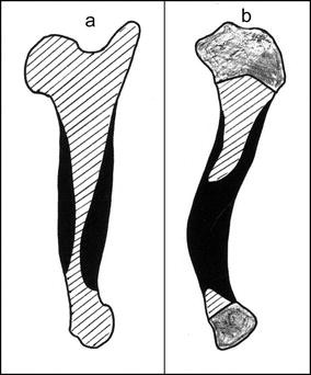An unusual form of congenital anterolateral tibial angulation—the delta  tibia