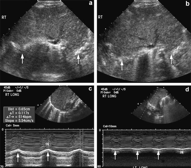 M-mode sonography of diaphragmatic motion: description of