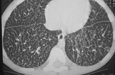 Niemann-Pick disease type B: HRCT assessment of pulmonary