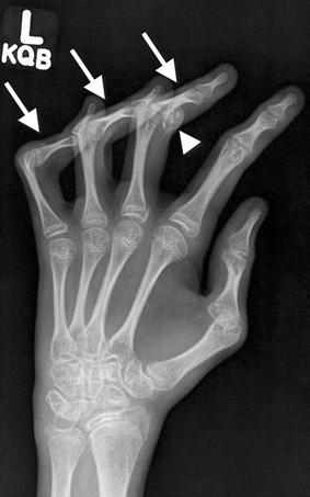 Arachnodactyly: fingers abnormally thin, long, and slender. The fingers