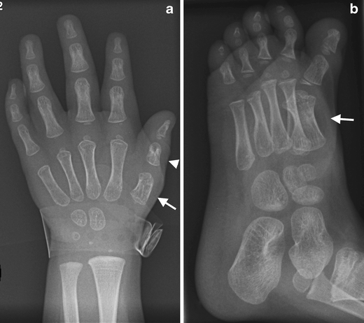 An unusual form of congenital anterolateral tibial angulation—the delta  tibia