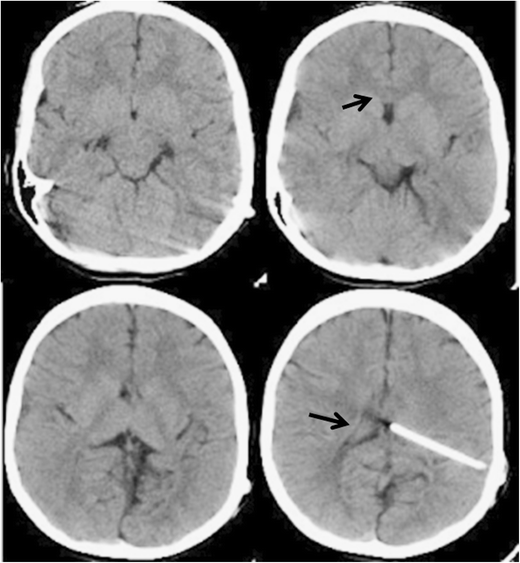 Neuroimaging of ventriculoperitoneal shunt complications in children