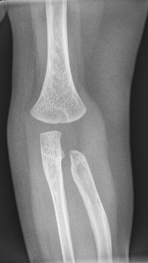 A case of bilateral elbow dislocation in a patient with Rubinstein