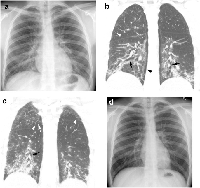 lung damage from e cigarettes E-cigarette or vaping product use-associated lung injury in the pediatric  population: imaging features at presentation and short-term follow-up |  Pediatric Radiology