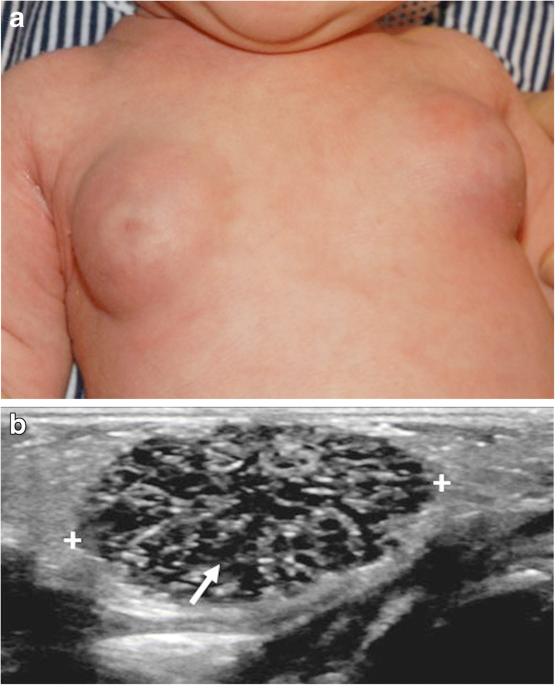 Breast development in pediatric patients from birth to puberty: physiology,  pathology and imaging correlation