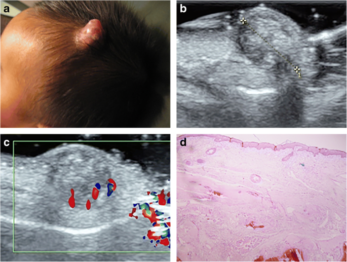 Multiple pilomatricomas in twins with Rubinstein-Taybi syndrome