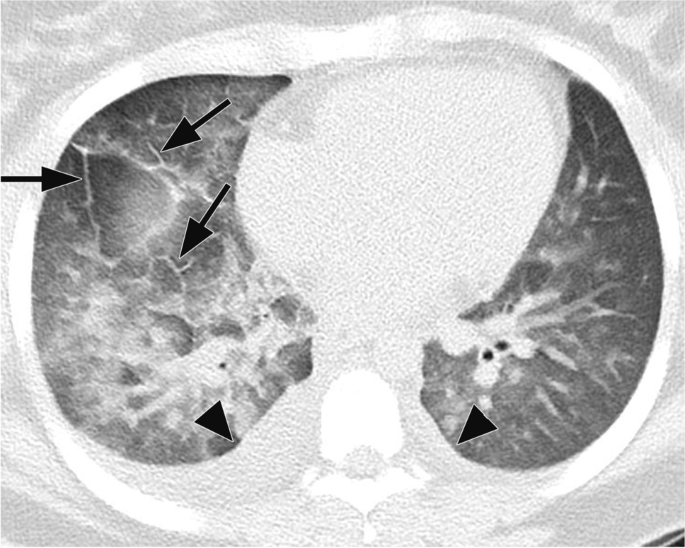 Acute Heart Failure in Multisystem Inflammatory Syndrome in