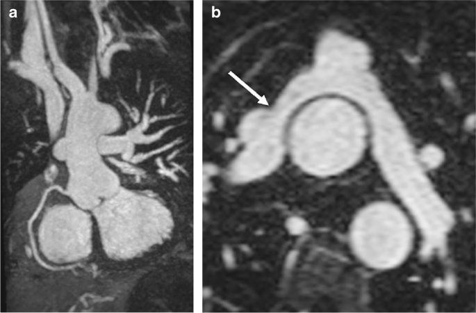 Bracco Diagnostics' MultiHance Contrast Agent Earns Expanded Labeling for  Pediatric MRI