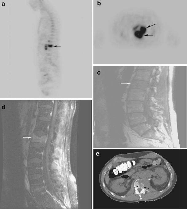 Use of FDG-PET in differentiating benign from malignant compression  fractures