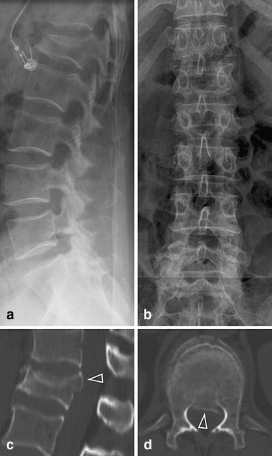Radiographic assessment of acute vs chronic vertebral compression fractures
