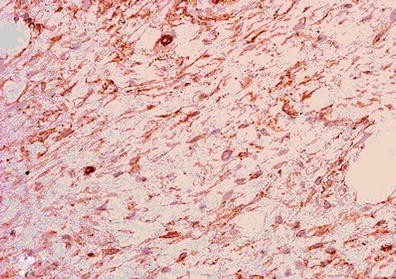 Spindle cell lipoma. (A) A fatty-tumor with interspersed fibro-myxoid