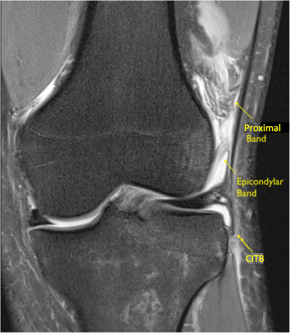 Magnetic resonance imaging appearances of the capsulo-osseous layer of the iliotibial  band and femoral attachments of the iliotibial band in the normal and  pivot-shift ACL injured knee | Skeletal Radiology