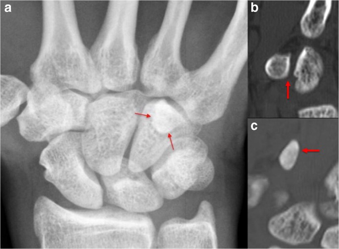 Radiographic signs of hook of hamate fracture: evaluation of diagnostic  utility | Skeletal Radiology
