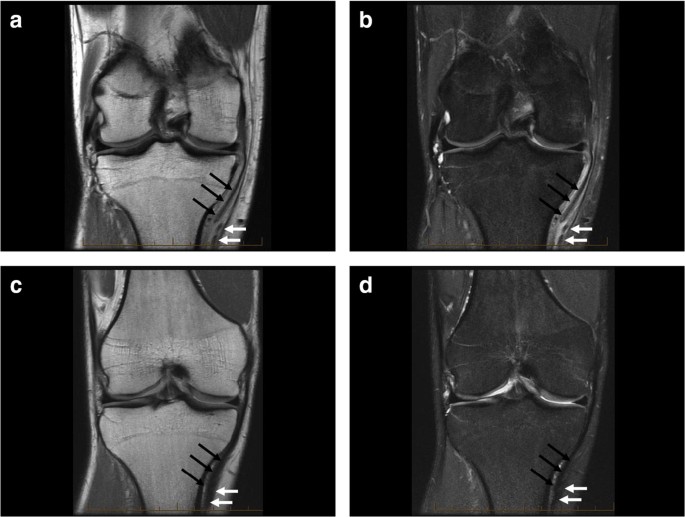 Tears in the distal superficial medial collateral ligament: the wave sign  and other associated MRI findings