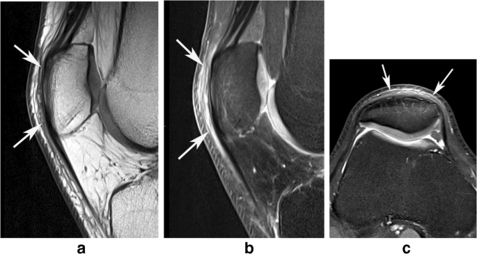 Posteromedial knee friction syndrome: Diagnosis by magnetic