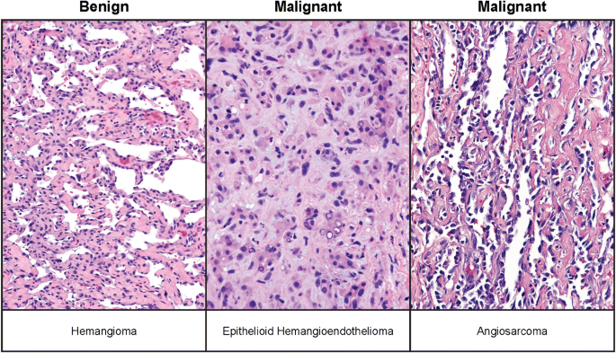 Soft tissue pathology for the radiologist: a tumor board primer with 2020  WHO classification update | Skeletal Radiology