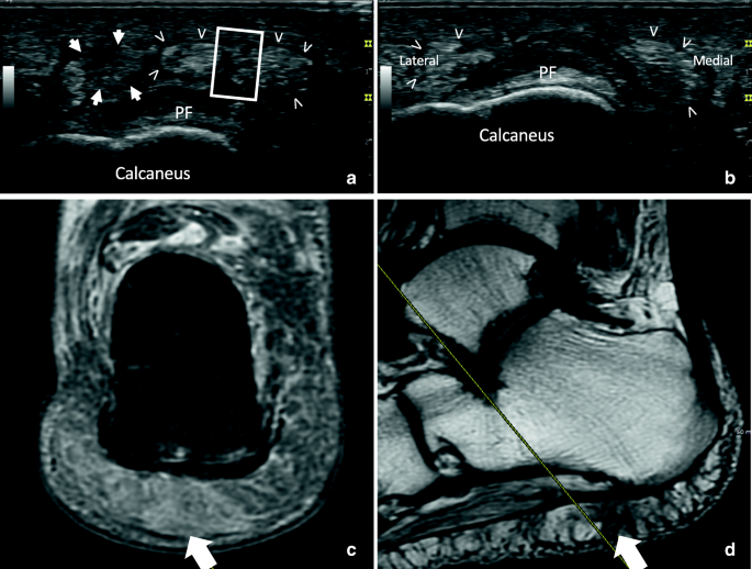 1) Plantar fascia and (2) heel fat pad measurements on ultrasound. (A)... |  Download Scientific Diagram